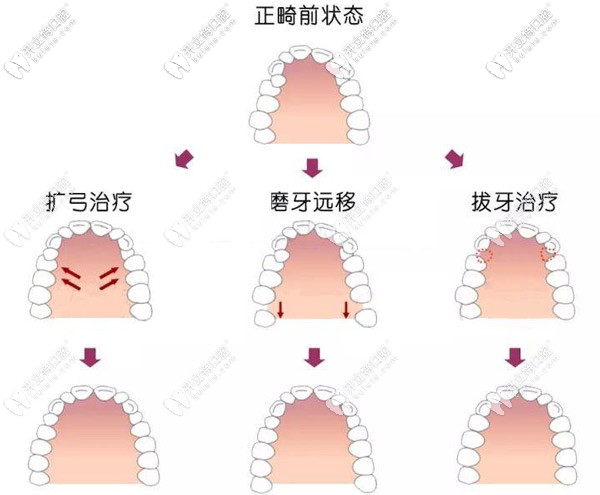 牙齒矯正使用擴(kuò)弓、磨牙遠(yuǎn)移、拔牙等都行