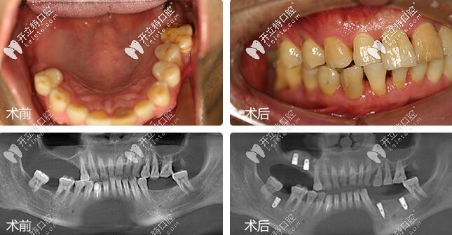 深圳麥芽口腔鄭蒼尚院長微創(chuàng)種植牙案例 深圳麥芽口腔鄭蒼尚院長微創(chuàng)種植牙案例