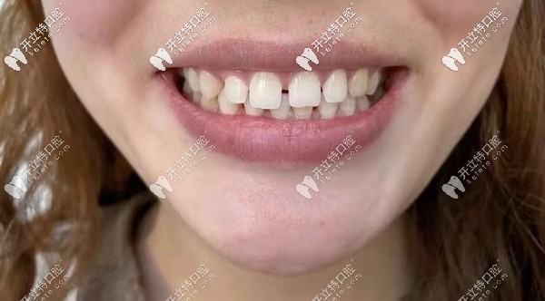 分享我門牙縫大做8顆美加全瓷牙貼面的案例感受，附效果圖