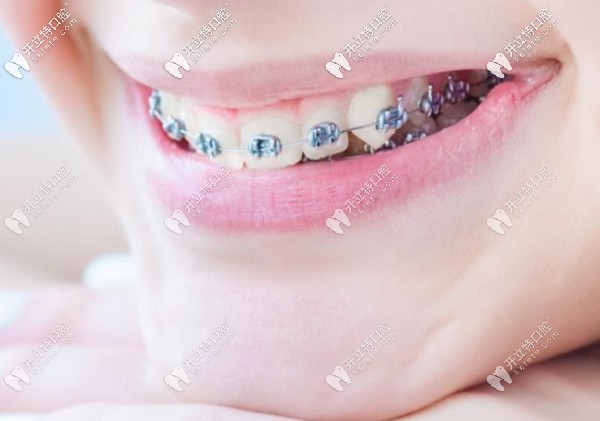 戴金碩自鎖托槽矯正示意圖