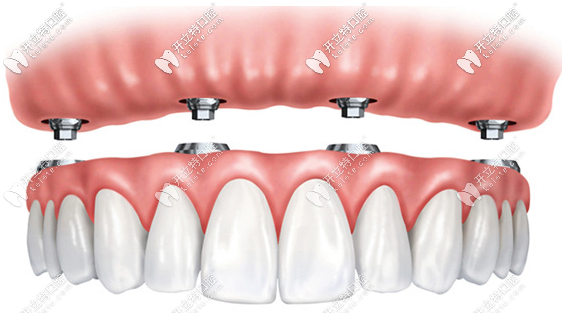 廣州半口種植牙價格