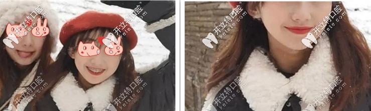 愛了愛了，簡直了，這矯正效果