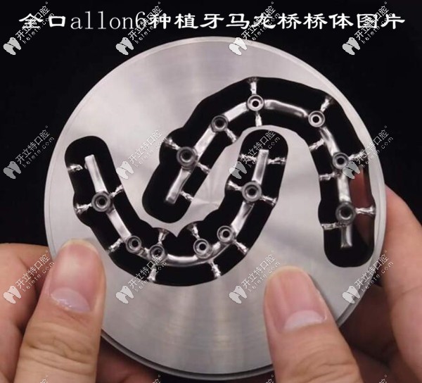 深圳馬瀧齒科做allon4馬龍橋種植牙怎么樣?優(yōu)缺點(diǎn)都在這嘍