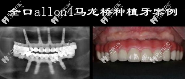 馬瀧齒科全口allon4馬龍橋種植牙案例圖片 馬瀧齒科全口allon4馬龍橋種植牙案例圖片