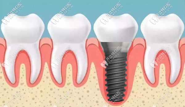 東營各口腔醫(yī)院價(jià)格表已出，瞅瞅東營做種植牙一般多少錢