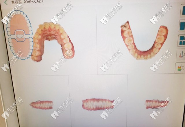 矯正口掃儀器可預(yù)見矯正結(jié)果