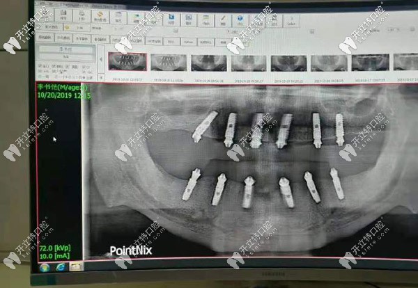全口即刻種植案例