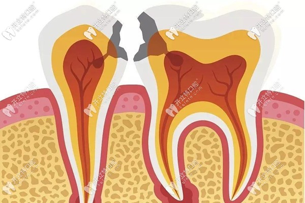 鄰面齲補(bǔ)牙怎么收費(fèi)?門牙或后牙補(bǔ)一顆的價(jià)格要三五百吧