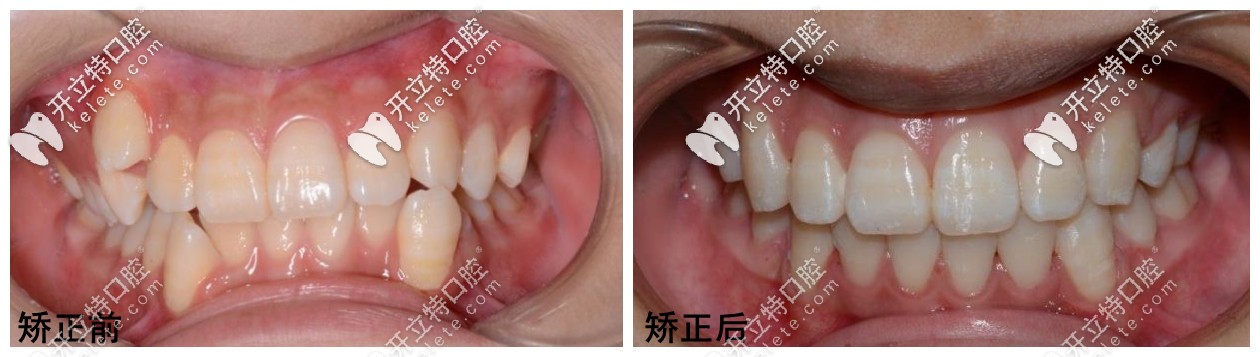 洛陽(yáng)維樂(lè)口腔矯正案例