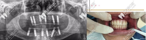 通過(guò)ALL-ON-6種植技術(shù)獲滿口好牙 通過(guò)ALL-ON-6種植技術(shù)獲滿口好牙