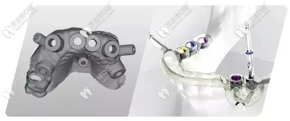 數(shù)字化導(dǎo)板種植的外觀 數(shù)字化導(dǎo)板種植的外觀