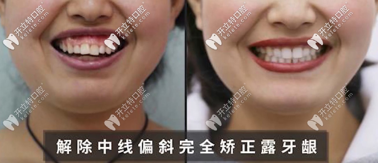 解決了露齦笑額齙牙的問(wèn)題，小姐姐笑的不要太開(kāi)心