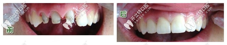 全瓷牙前后對比照片圖