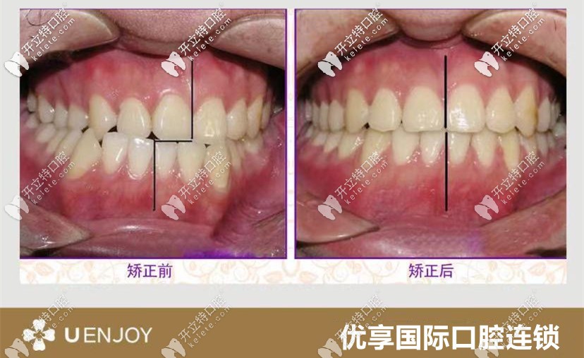 張醫(yī)生：獨(dú)特設(shè)計(jì)中線偏離矯正案例