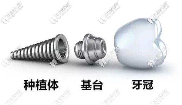 種植牙由種植牙、基臺(tái)及牙冠組成