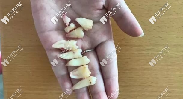 一次性拔掉8顆牙齒的我