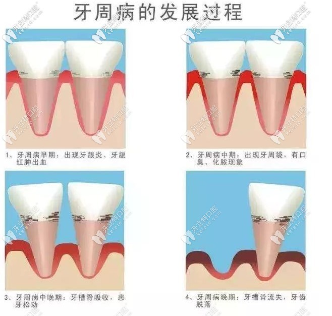 牙周病的發(fā)展過程