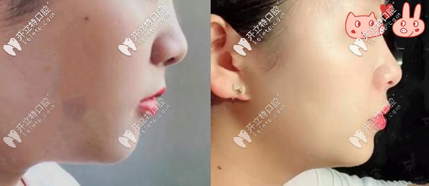 1年后側(cè)面對比圖，效果顯著