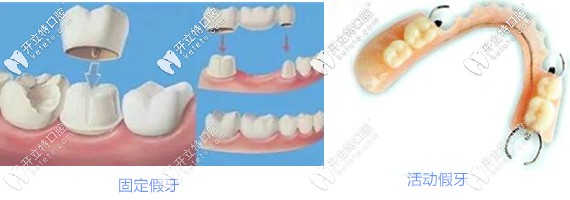 烤瓷牙和活動義齒區(qū)別 烤瓷牙和活動義齒區(qū)別