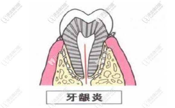 牙齦炎的圖片和癥狀