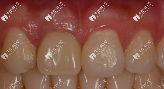 即刻種植術后帶上牙冠的樣子