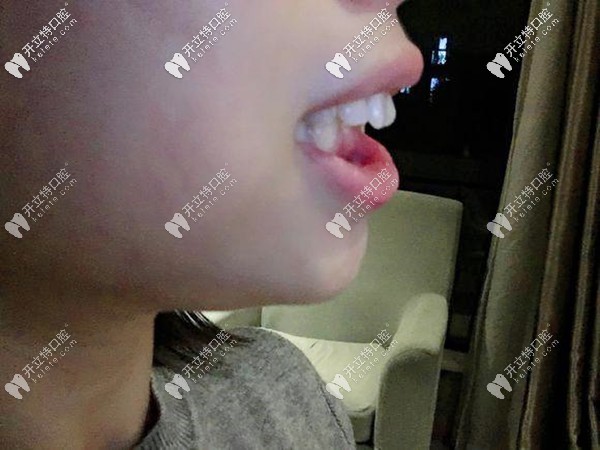 35歲骨性深覆合可以做舌側(cè)隱形矯正嗎?聽說(shuō)花5萬(wàn)臉型改變大