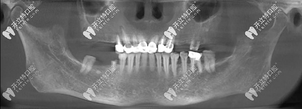 15分鐘種3顆牙的王阿姨感言：德國生長因子種植牙技術真牛