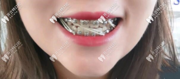 牙齒矯正：要經(jīng)歷皮筋牽引階段的