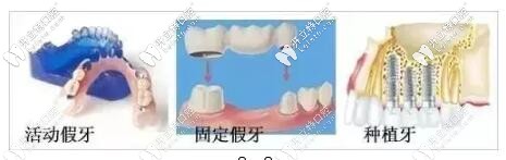 鑲牙的三種方式 鑲牙的三種方式