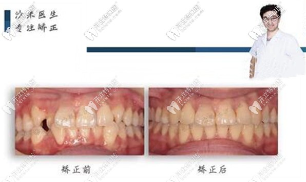 網(wǎng)友評價：牙祖口腔沙米醫(yī)生做隱適美牙齒矯正挺靠譜！