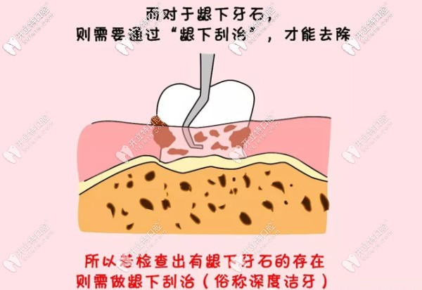 齦下刮治能夠緩解牙齦炎癥