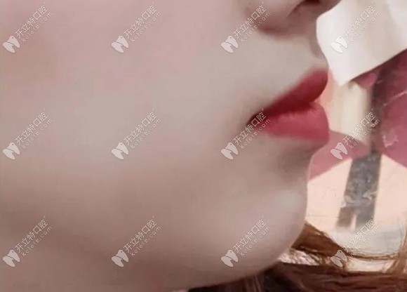 矯正齙牙后的側(cè)面效果圖