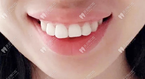 矯正前的齙牙齒圖片