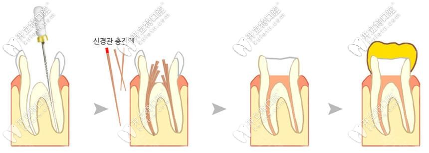 根管治療步驟過程及動畫視頻圖解,看根管治療4次哪次比較痛