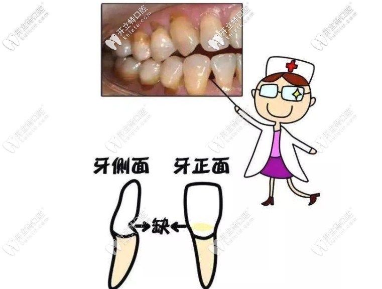 其實(shí)很多楔狀缺損都是刷牙導(dǎo)致的，早發(fā)現(xiàn)早治療哦~