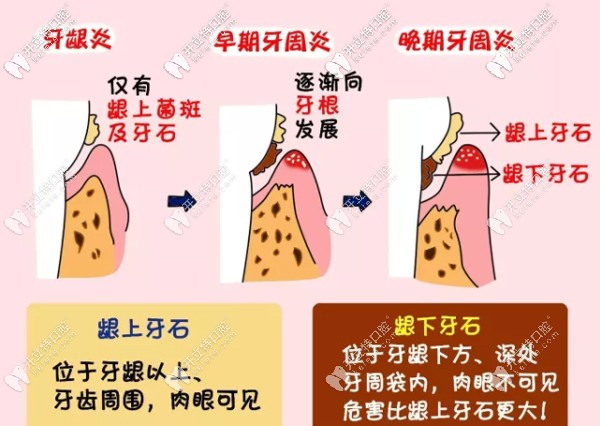 牙周刮治的利與弊