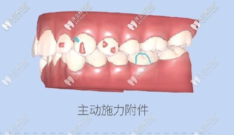 附件會(huì)對(duì)牙齒進(jìn)行施力