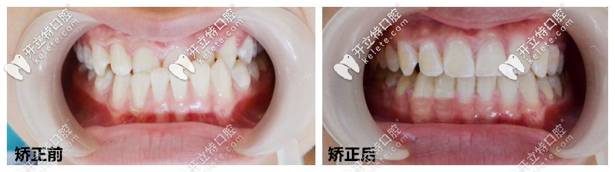 地包天矯正后的前后對(duì)比