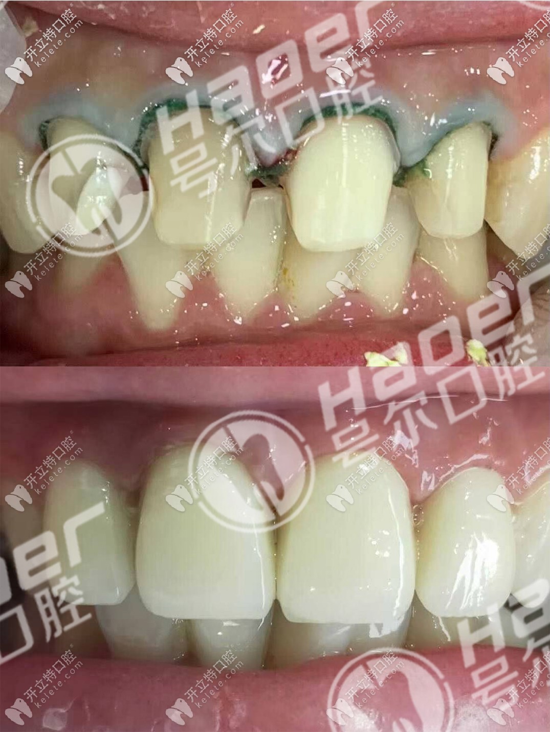 說(shuō)不痛苦是假的,談?wù)勎铱敬裳烙?年后拆了換全瓷牙過(guò)程！