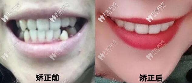 正畸案例：妹妹中線不齊+臉歪做的金屬自鎖矯正后圖片分享