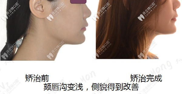 從隱適美矯正骨性深覆合的過(guò)程看,前后臉型變化確實(shí)不小