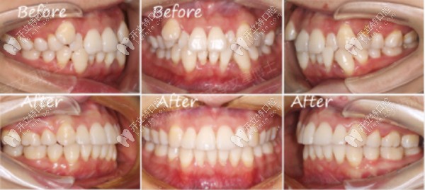 牙列擁擠不齊+個別牙反頜+虎牙矯正案例