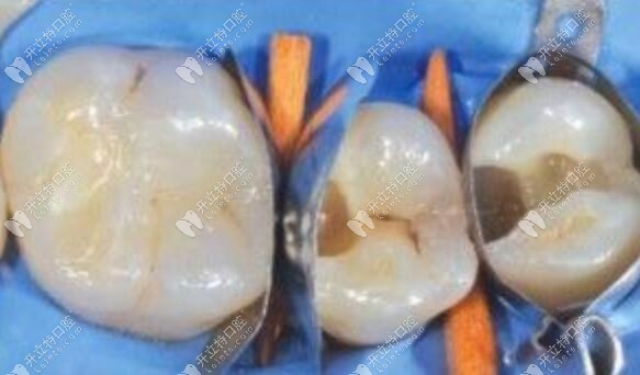 牙齒缺損補(bǔ)牙后