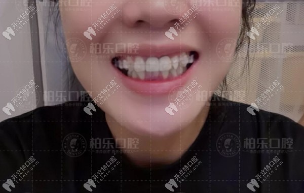 剛帶上陶瓷隱形牙套