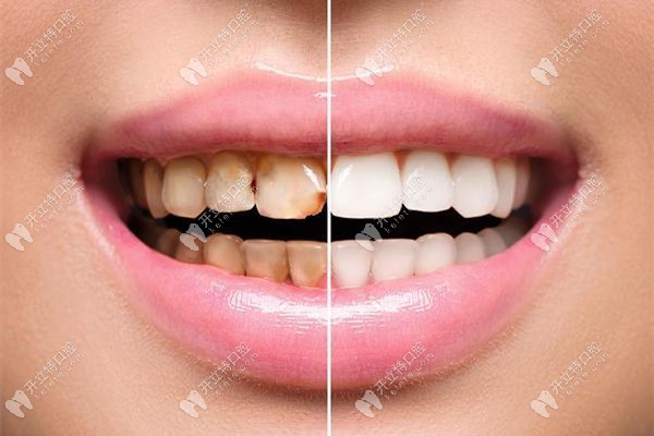 網紅推薦的美白牙貼和瓷貼面美白牙齒的效果比怎么樣?