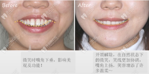 開頜+牙齒中線不齊