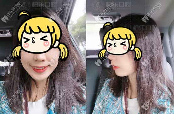 牙齒深覆合的我矯正臉型變化圖