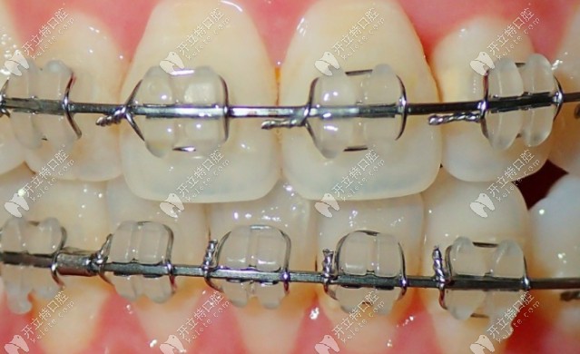 陶瓷半隱形矯正