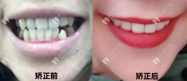 通過3年矯正變化，現(xiàn)在我的牙齒美美噠