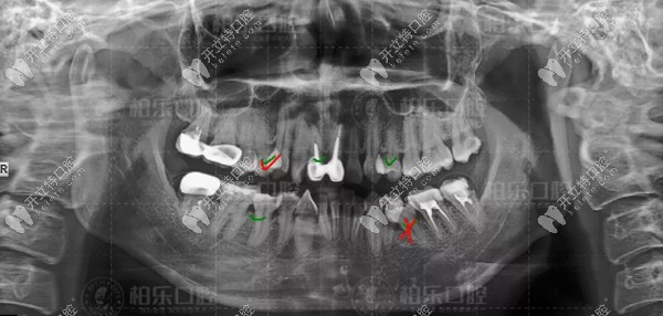 口腔檢查我的牙片